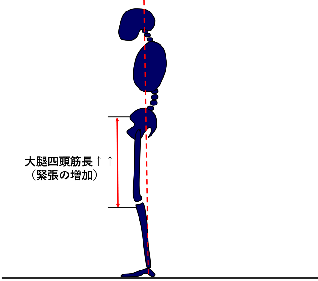 骨盤後傾位の立位姿勢